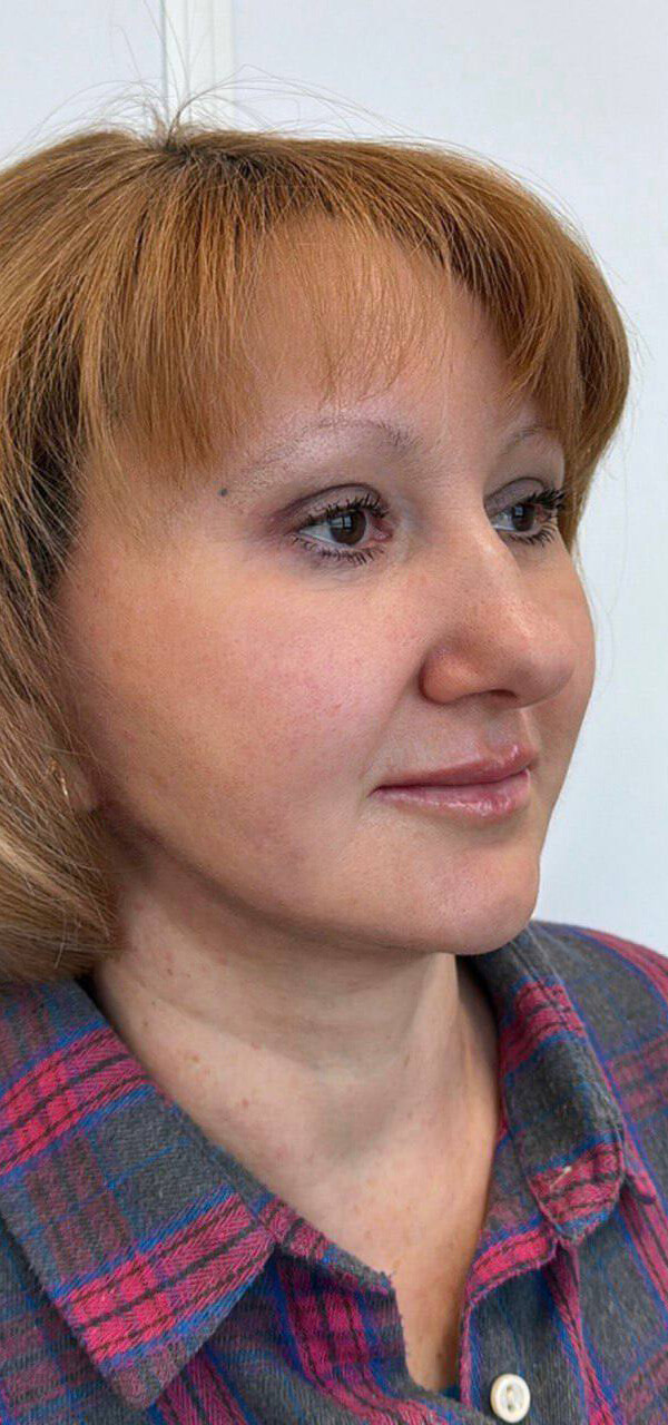 После процедуры